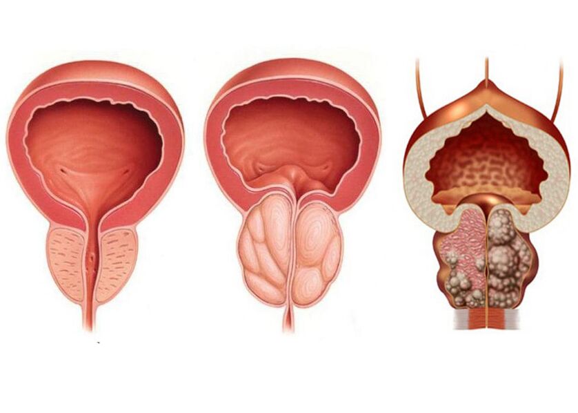 Etapas de prostatitis y la necesidad de usar completamente la prostavit