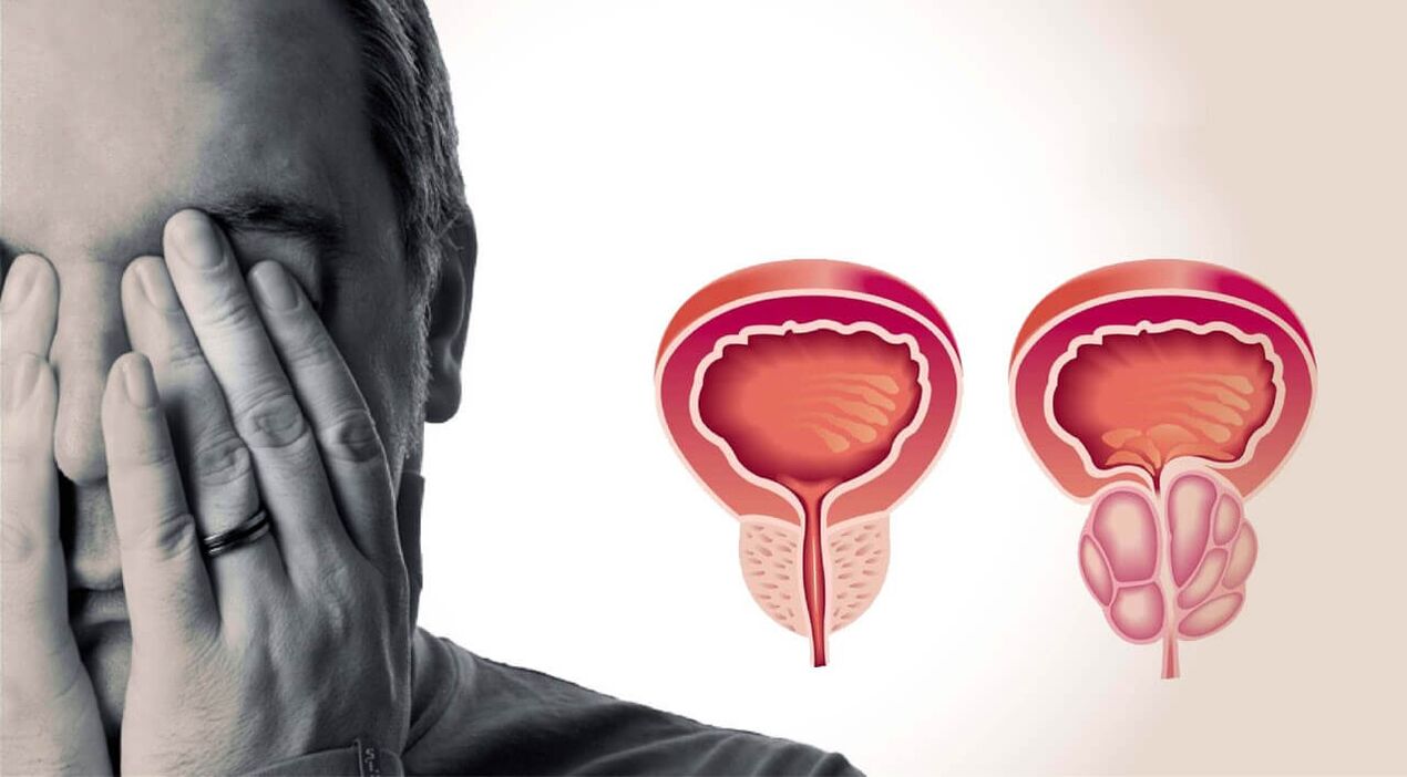 Prostata sana y dolorida en los hombres